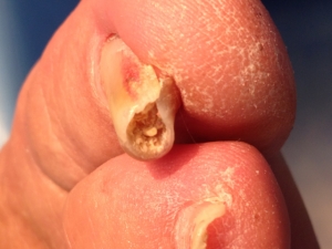 Onicauxis. Curvadura de la uña primer dedo.